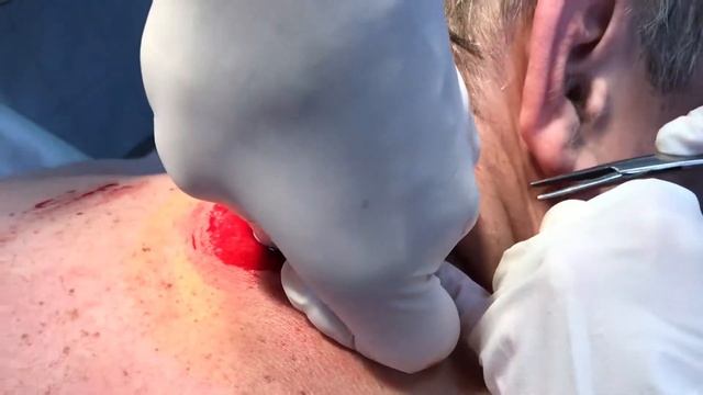 ЛИПОМА ШЕИ смотреть онлайн