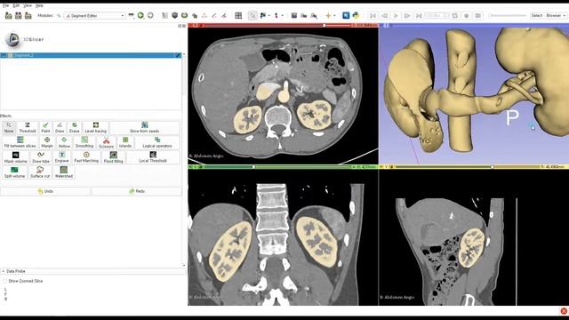 3D Slicer Tutorial_Abdomen CT(Kidneys) смотреть онлайн