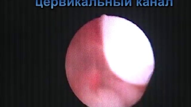 Подозрение на полип на основании в матке. Гистера. смотреть онлайн