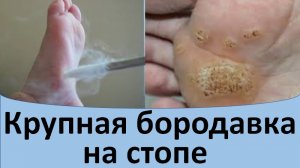 Крупные бородавки на стопе.