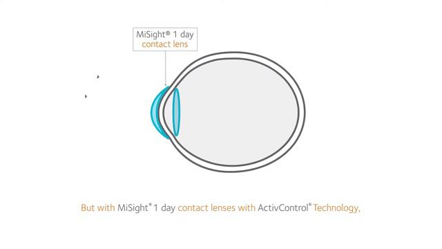How does MiSight work? смотреть онлайн