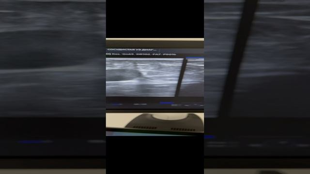 Лечение варикоза. Неправильная тактика. Ошибка хирурга. Операция. Флеболог. Флеболог Москва смотреть онлайн