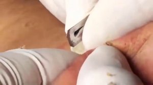 удаление прыщей уха уход за кожей#003