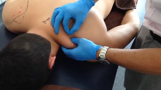 Dry Needling: Trapezius смотреть онлайн