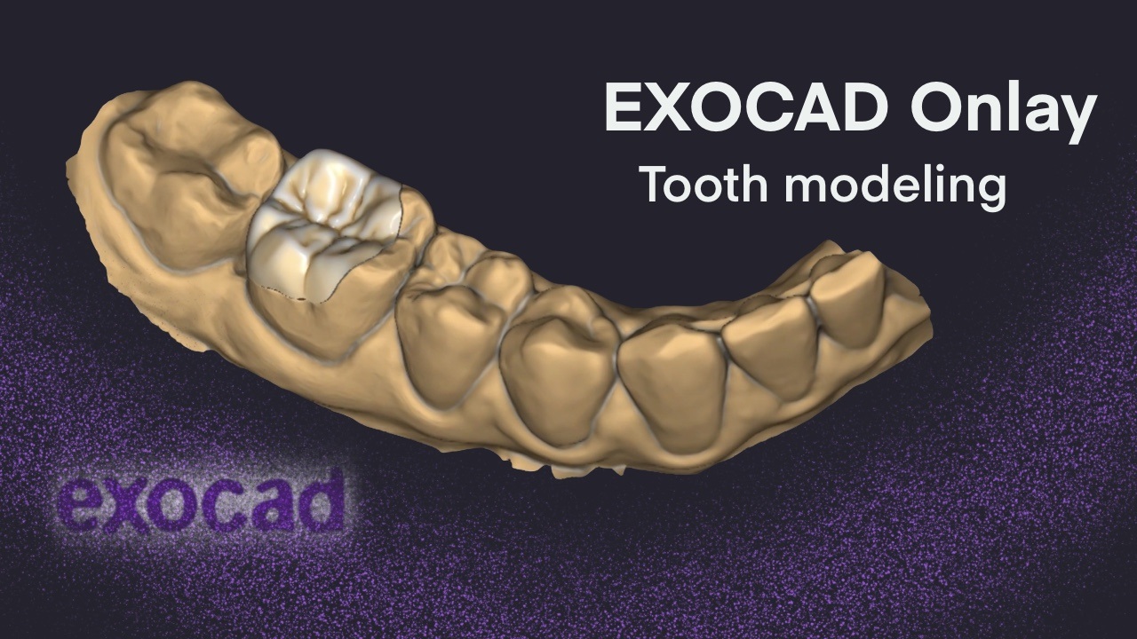 Exocad  Onlay I Tooth Modeling 3