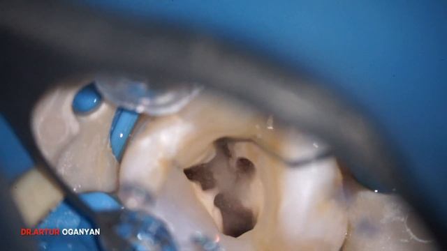 Промывание 6-ти канального зуба под микроскопом! смотреть онлайн