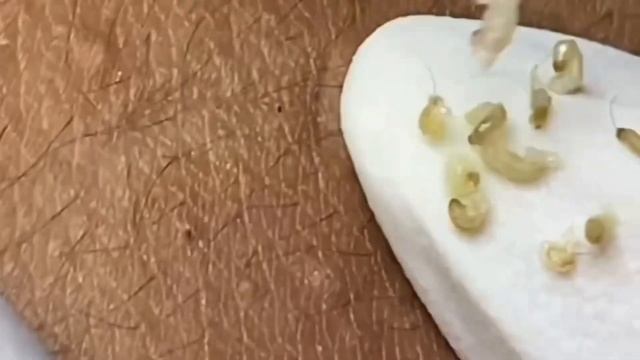 Смотри как ДАВИТЬ ПРЫЩИ на спине смотреть онлайн