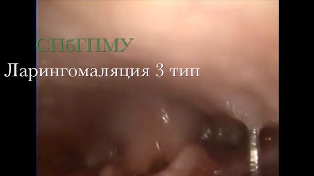 Ларингомаляция 3 тип - Laryngomalacia