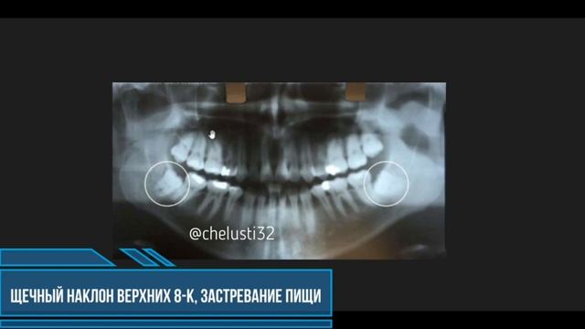 Зубы мудрости. Почему многим они доставляют проблемы и что с этим делать? смотреть онлайн