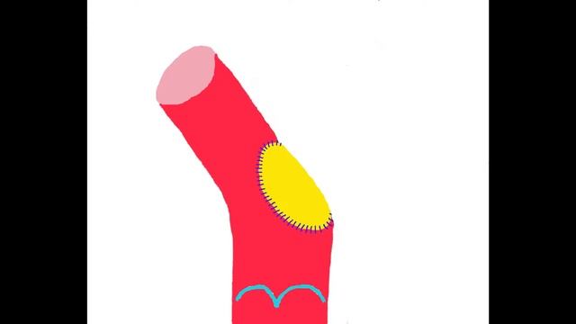 Левосторонняя пневмонэктомия с резекцией легочного ствола и аорты (РНЦХ им.акад.Б.В.Петровского) смотреть онлайн