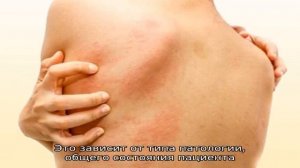 Сколько длится и как долго проходит крапивница у взрослых