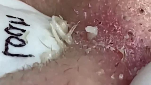 Выдавливание прыщей. Угри. Акне