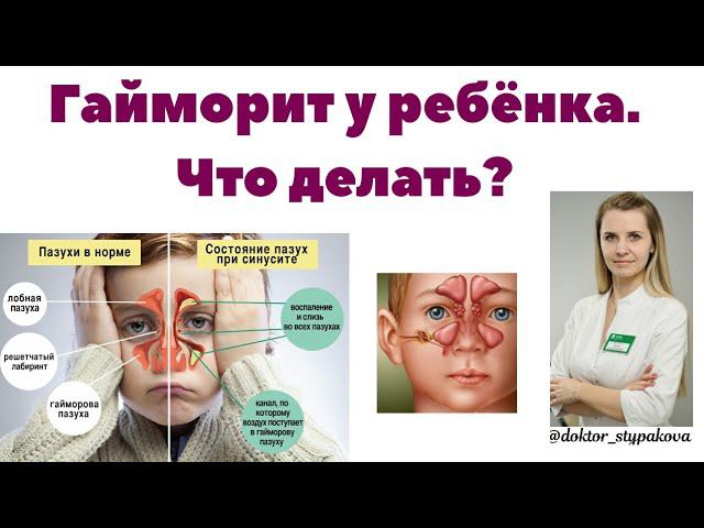 Гайморит у ребёнка.Симптомы болезни.Отличия гайморита от обычного ринита у детей. смотреть онлайн