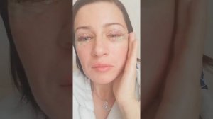 1й день после блефаропластики