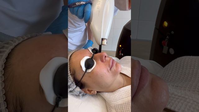 Как убрать сосуды? Удаление сосудов с лица в клинике косметологии GEN87 #shorts смотреть онлайн