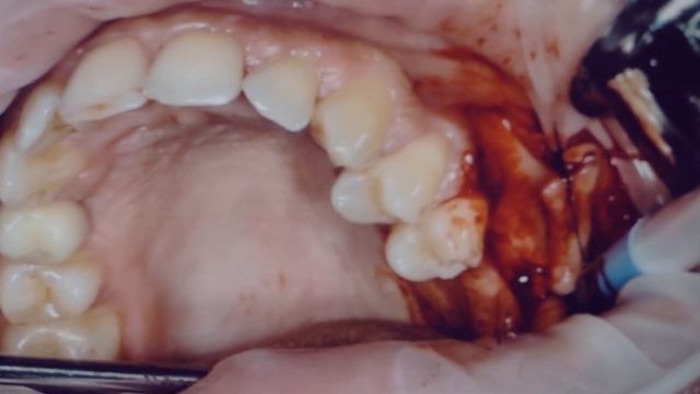 Curs Sinus Lifting смотреть онлайн