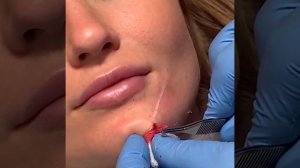 Удаление корейской нити коги