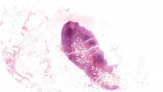 5X lymph node micrometastasis смотреть онлайн