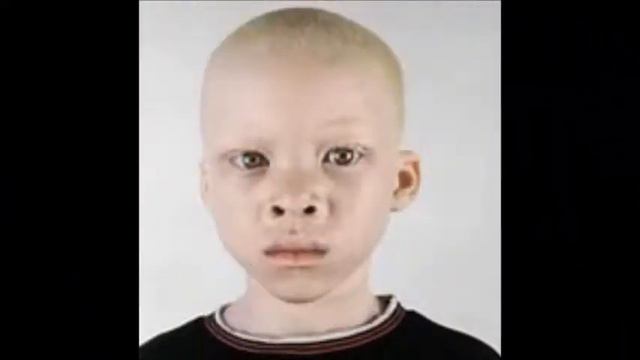 Beautiful Faces of Albinism смотреть онлайн