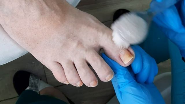 ВРОСШИЙ НОГОТЬ / тампонада INGROWN TOENAIL / Tamponade