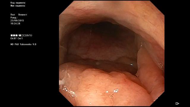 Adenoids of 2’d degree by flexible EGD. Аденоиды 2-й степени смотреть онлайн