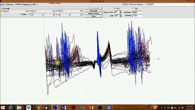 DEXTRONIX- How to analyze an ECG using CardioExplorer смотреть онлайн