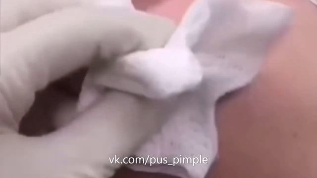 Канал Прыщик _ Pus Pimple Intro