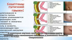 Пупочная грыжа у детей: как определить и лечить пупочную грыжу у ребенка? Заговор грыжи у младенце.