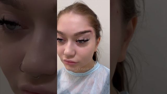 Нитевая подтяжка бровей #shotrs смотреть онлайн