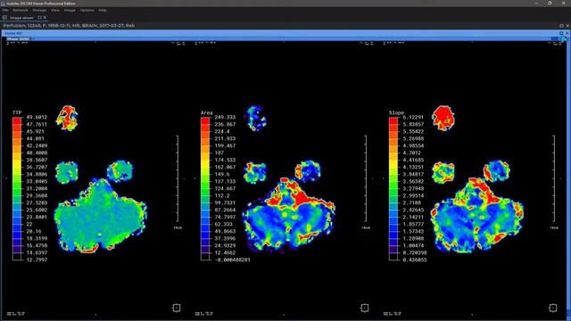 Simultaneous display of the maps in Perfusion Mode of Inobitec DICOM Viewer Pro смотреть онлайн