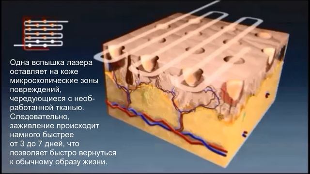 Стань принцессой к Новому году! Лазерное омоложение в клинике "Доктор Борменталь" смотреть онлайн
