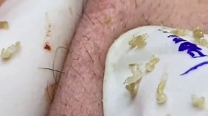Blackheads extraction on face (n12)