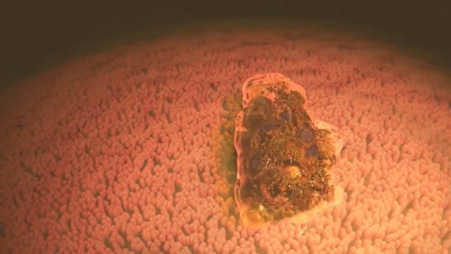 Entamoeba Histolytica