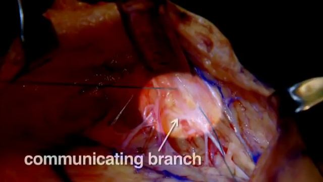 The Technique for Complete Composite Facelift - Dr Bryan Mendelson смотреть онлайн
