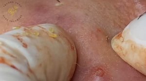 Big Pimples | Acne Treament Under The Skin #027