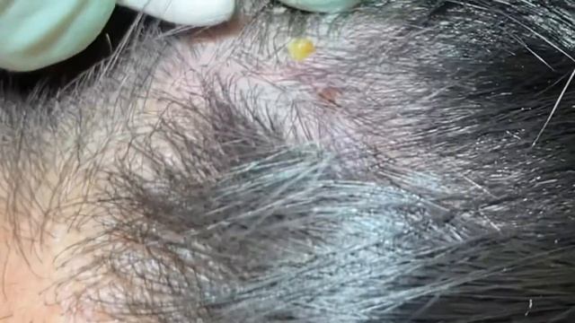 Acne Extractions 2.0 session #4. Blackheads, whiteheads. Wait for the last pop, it’s got distance! смотреть онлайн