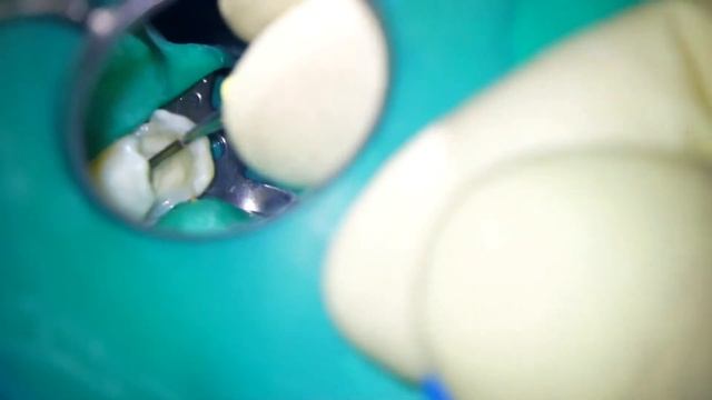 Сломанный инструмент в 15 зубе смотреть онлайн