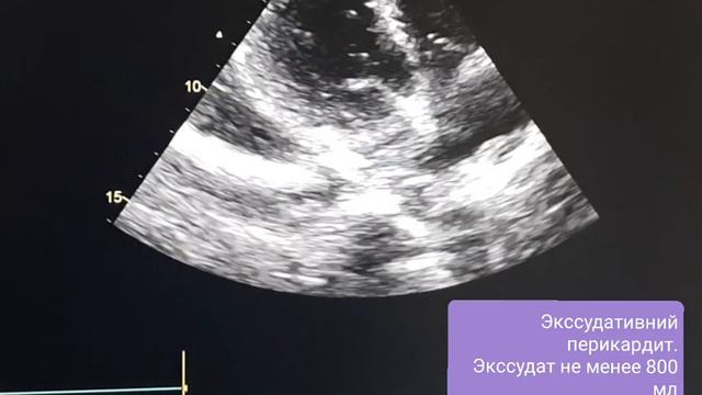 ТАМПОНАДА СЕРДЦА.Экссудат не менее 1000 мл смотреть онлайн