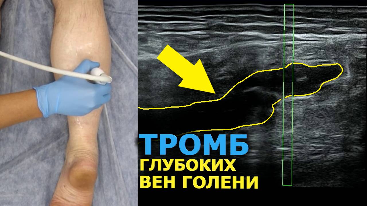 Тромб Глубокой Вены Голени