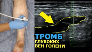 Тромб Глубокой Вены Голени