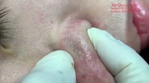 Removes acne, Давим прыщи, чёрные точки. Залипательно 2021