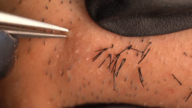 Removing Embedded Hairs From A Asian Laser Hair Removal 20210509