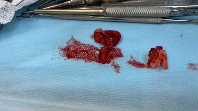 Удаление огромной кисты зуба. Удаление зуба с кистой смотреть онлайн