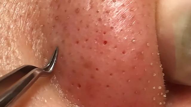 Pimple Popping - Skin Care