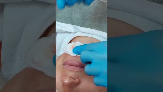 DMAE LIFT ELDERMAFILL. КАНЮЛЬНАЯ ТЕХНИКА.