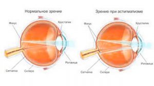 Патологии роговицы глаза и виофтаны, рассказывает Михаил Сергеевич Краснов.
