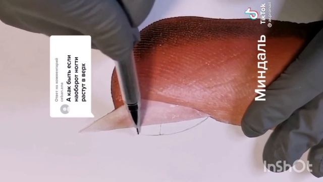 Вверх растущие ногти. Трамплины (в простонародье) смотреть онлайн