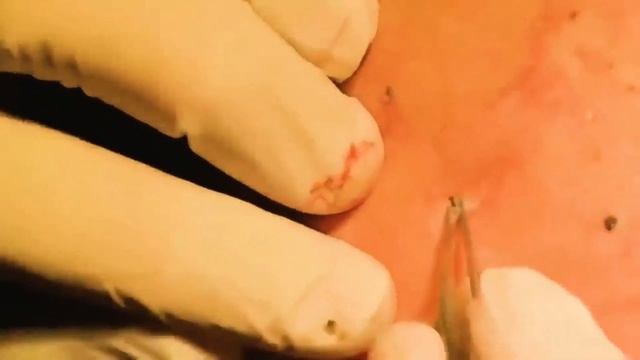 Прыщи на спине! Выдавливание прыщей,выдавливание черных точек! смотреть онлайн