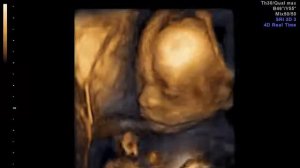 18 недель 4д узи