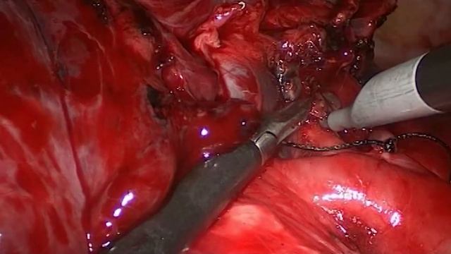 Asvide: VATS right upper lobectomy and systematic lymph node dissection for lung cancer смотреть онлайн